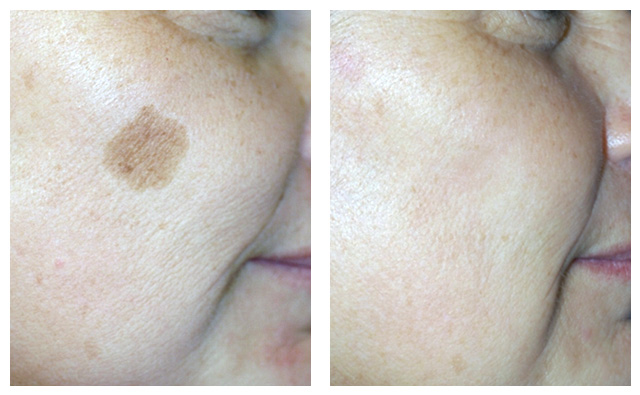Age & Sun Spots Laser Treatment Before & After Pictures