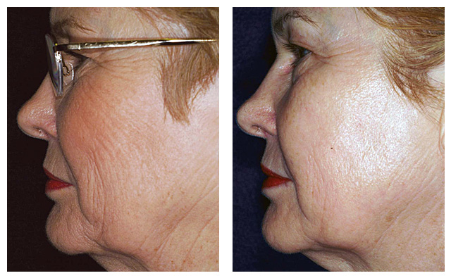 Laser Skin Tightening Before & After Photos