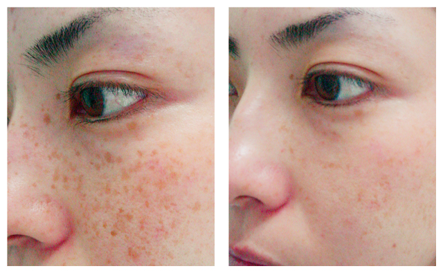 Age & Sun Spots Laser Treatment Before & After Pictures